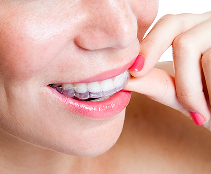 Orthodontic Retainers in Lakewood CA