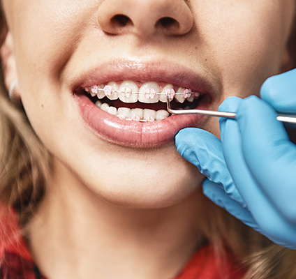 Porcelain Ceramic Braces in Lakewood CA