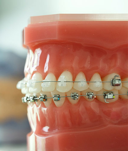 Invisalign Bixby Knolls CA