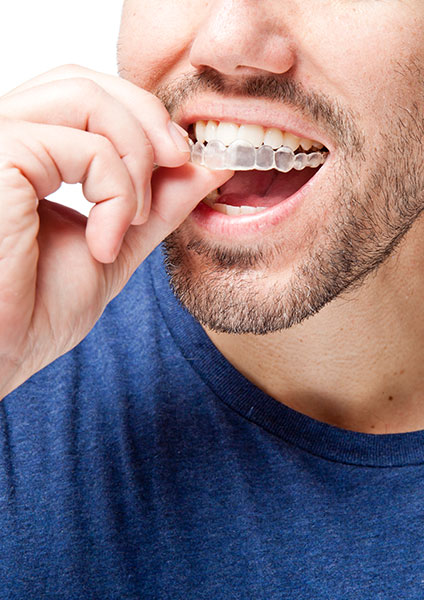Invisalign Long Beach CA