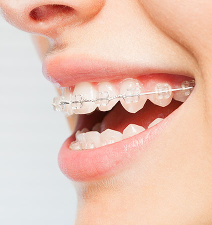Invisalign Bixby Knolls CA